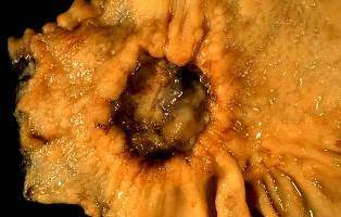 Gastric Cancer
